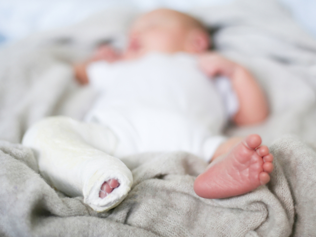 حنف القدم عند حديثي الولادة
